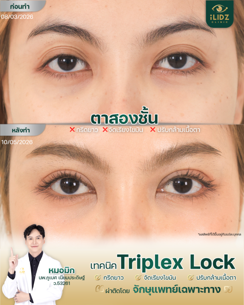 กล้ามเนื้อตาอ่อนแรง (Ptosis Correction) ผลลัพธ์ก่อน-หลัง iLIDZ Clinic โดยจักษุแพทย์