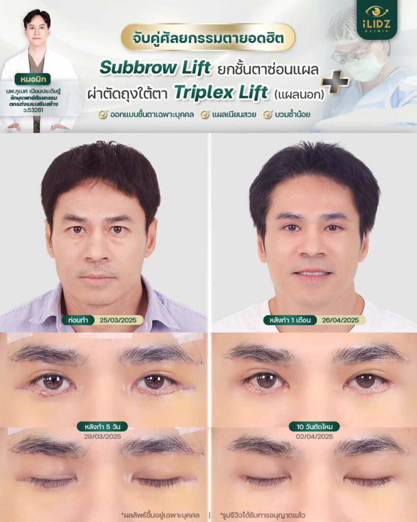 subbrow lift
