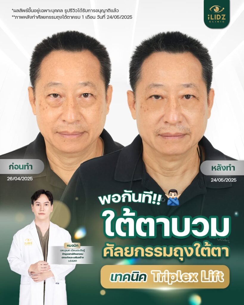 ผ่าตัดถุงใต้ตา
