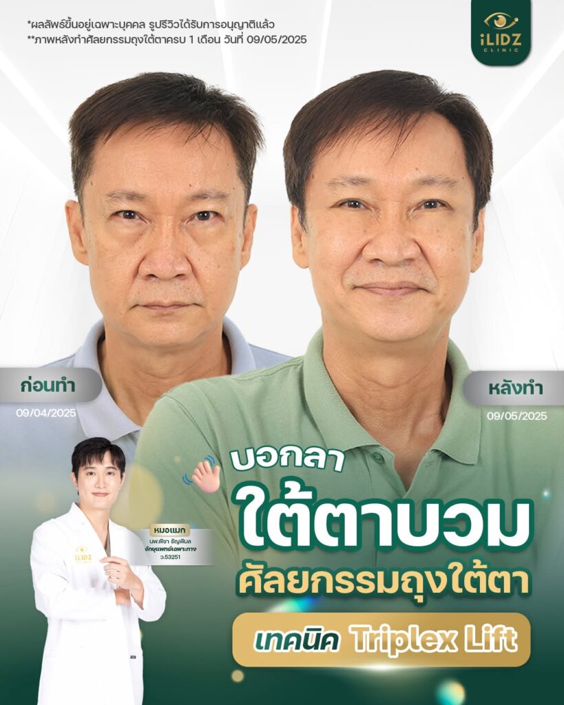 ผ่าตัดถุงใต้ตา
