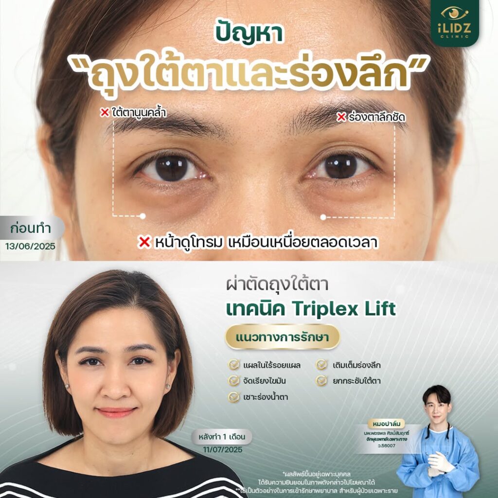 จัดเรียงไขมันใต้ตา