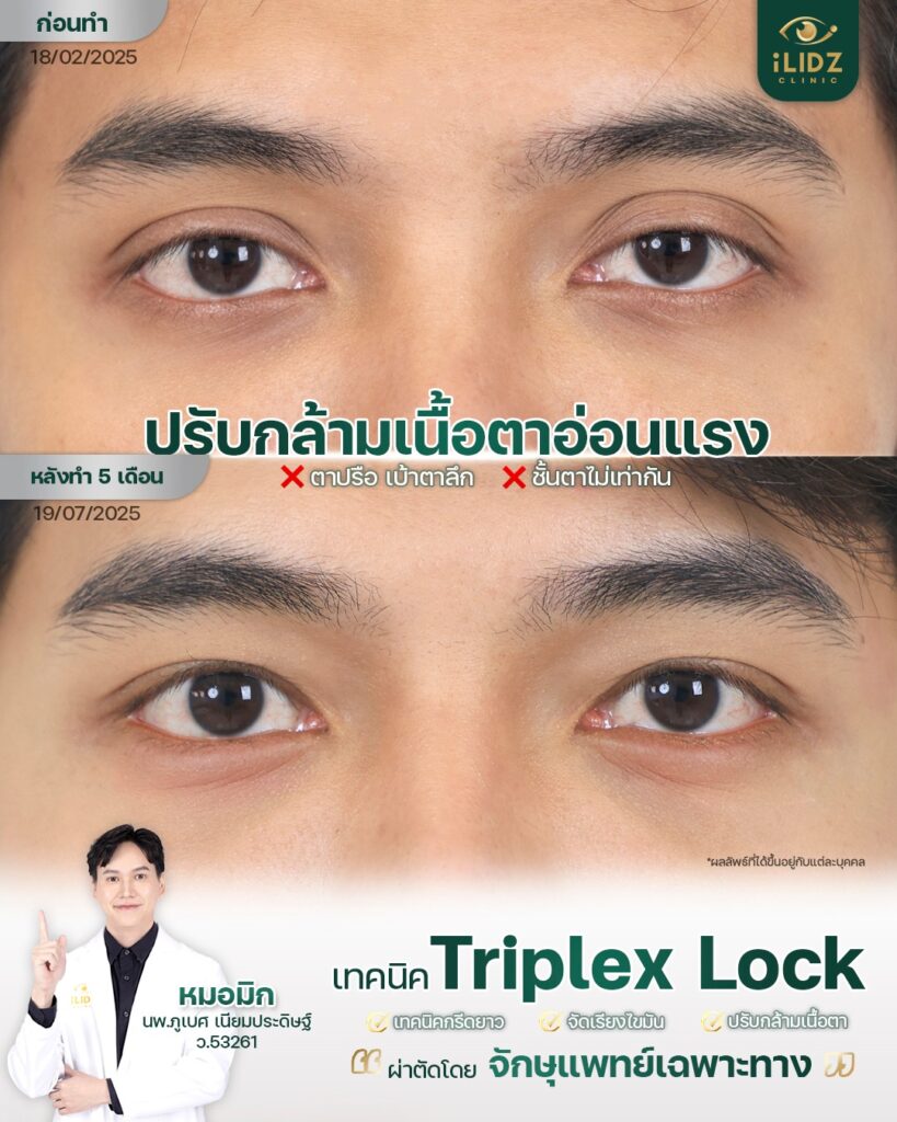 ผลการรักษากล้ามเนื้อตาอ่อนแรง (Ptosis Correction) ก่อน-หลัง iLIDZ Clinic