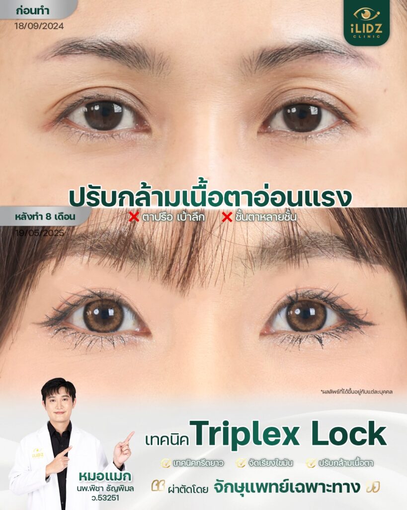 ผลการรักษากล้ามเนื้อตาอ่อนแรง (Ptosis) iLIDZ Clinic ก่อน-หลัง