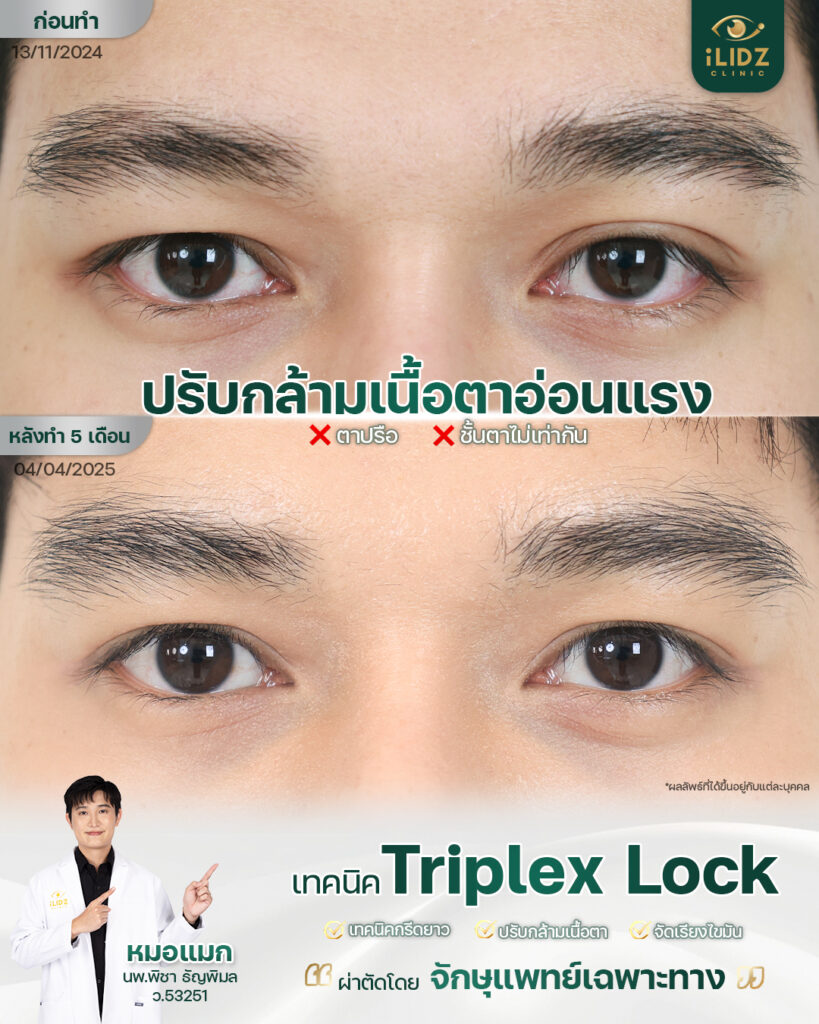 ก่อน-หลังปรับกล้ามเนื้อตาอ่อนแรง (Ptosis) เทคนิค Triplex Lock iLIDZ Clinic