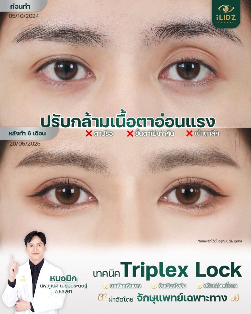 ปรับกล้ามเนื้อตาอ่อนแรง (Ptosis) โดยจักษุแพทย์ iLIDZ Clinic ก่อน-หลัง