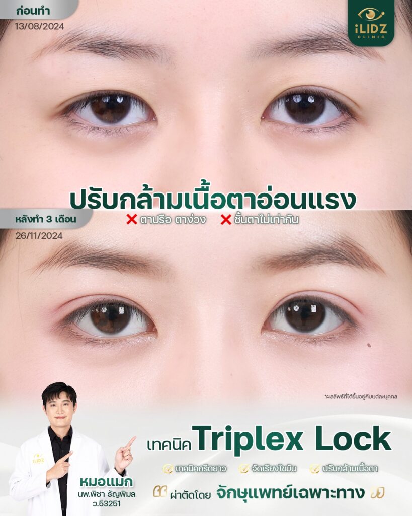 แก้ Ptosis กล้ามเนื้อตาอ่อนแรง ผลลัพธ์ก่อน-หลัง โดยจักษุแพทย์ iLIDZ Clinic