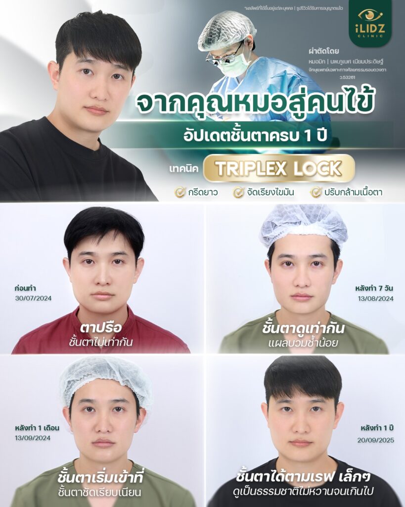 ตาสองชั้น ปรับกล้ามเนื้อตาอ่อนแรง