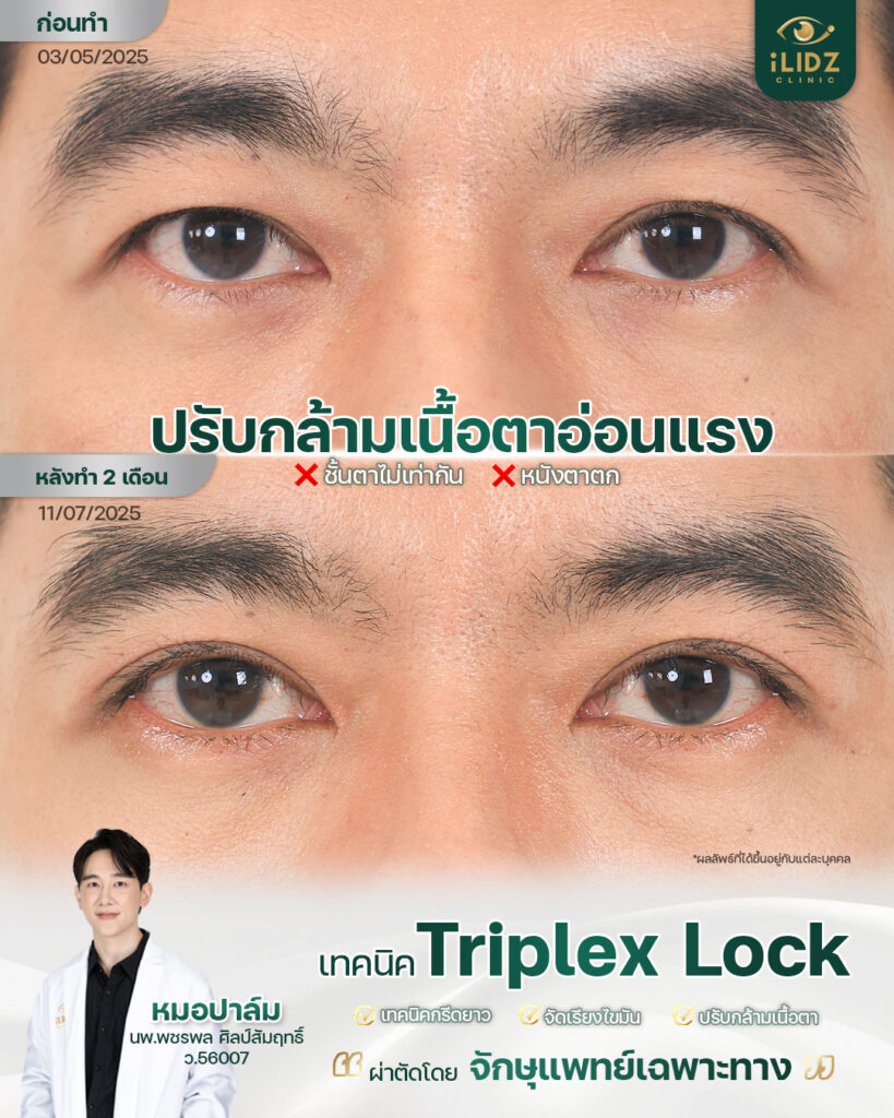 เคสรีวิวกล้ามเนื้อตาอ่อนแรง (Ptosis) หลังการรักษา iLIDZ Clinic