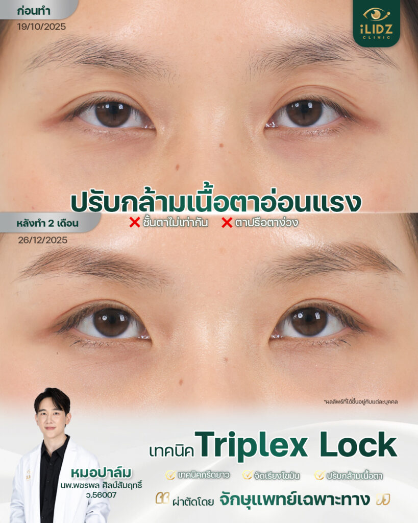 เคสปรับกล้ามเนื้อตาอ่อนแรง (Ptosis) หลัง 2 เดือน iLIDZ Clinic