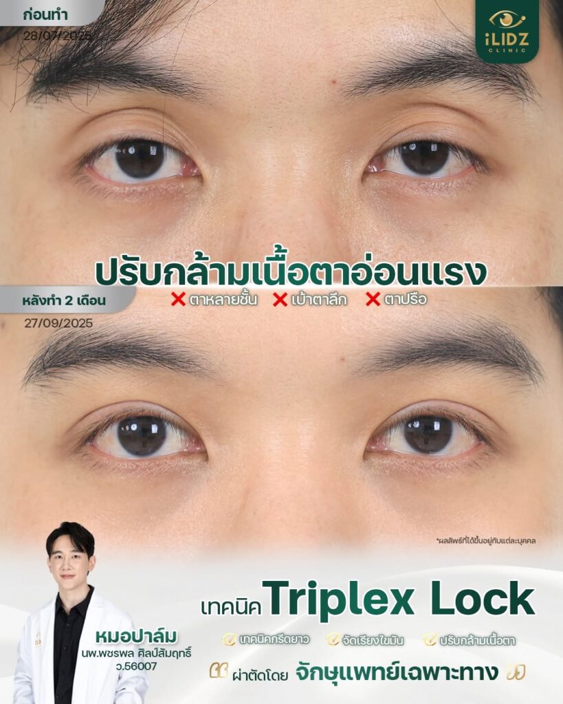 ตาสองชั้น ปรับกล้ามเนื้อตาอ่อนแรง