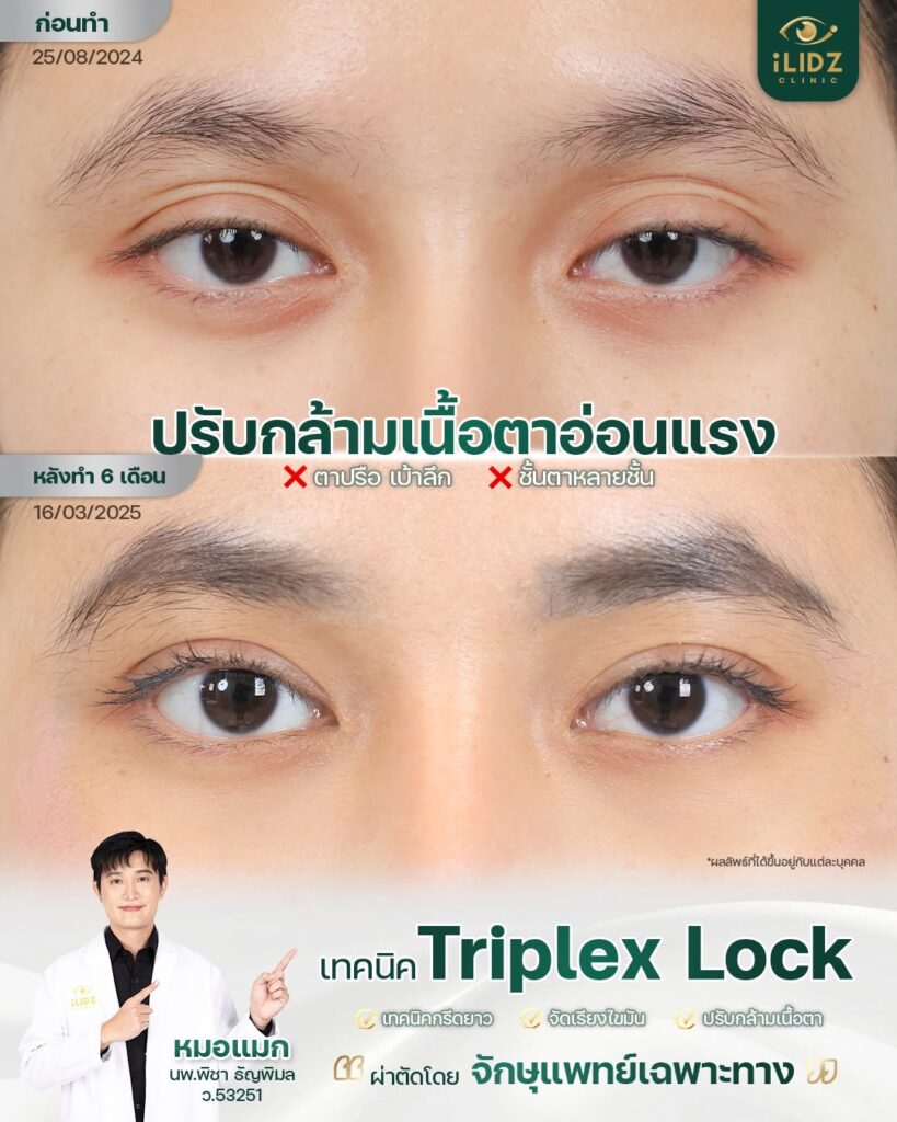 ตาสองชั้น ปรับกล้ามเนื้อตาอ่อนแรง
