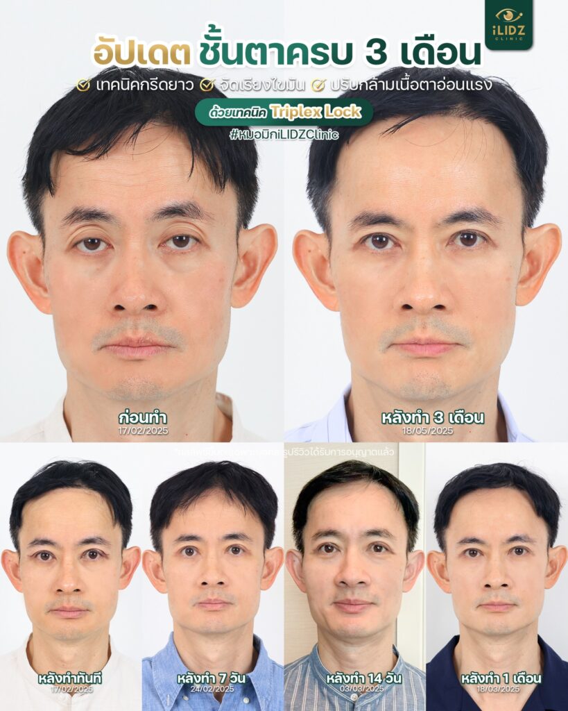 ตาสองชั้น ปรับกล้ามเนื้อตาอ่อนแรง
