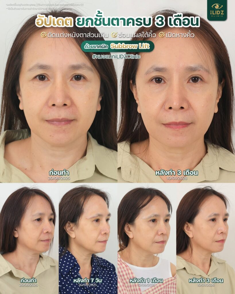 subbrow lift