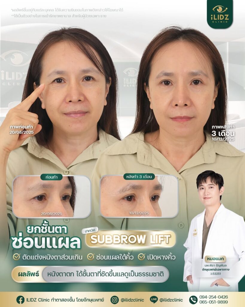 subbrow lift