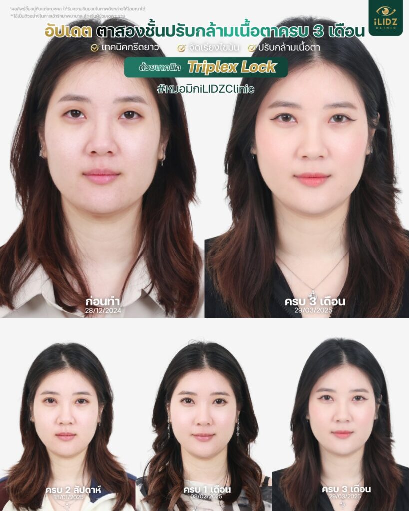 ตาสองชั้น ปรับกล้ามเนื้อตาอ่อนแรง