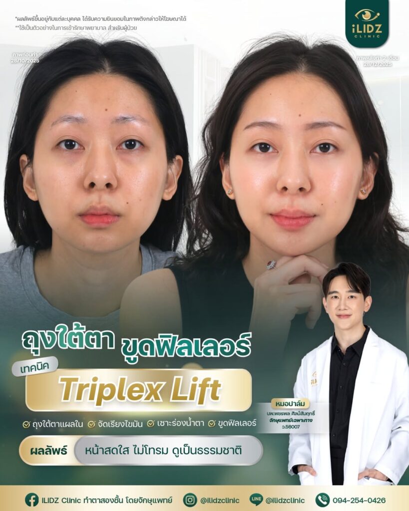 ผ่าตัดถุงใต้ตา