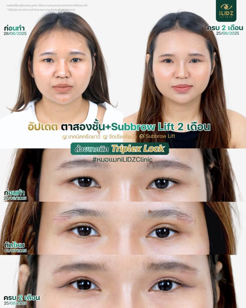 subbrow lift