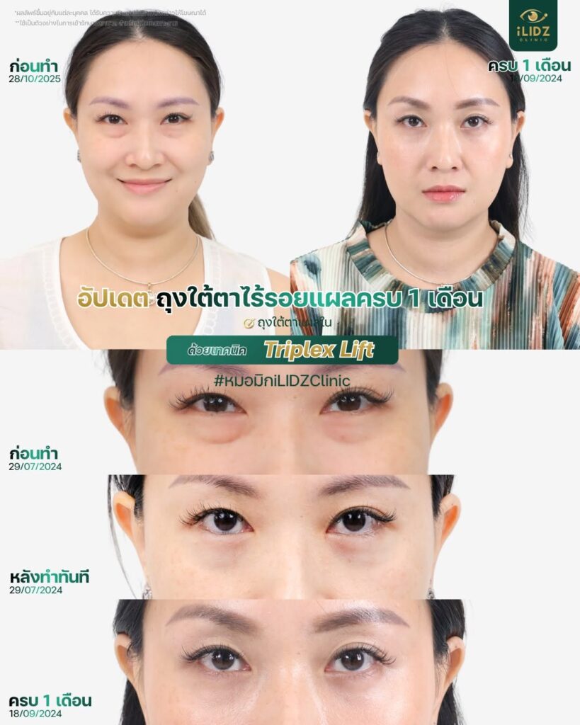ผ่าตัดถุงใต้ตา