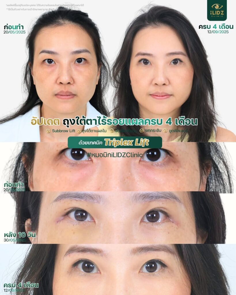 subbrow lift