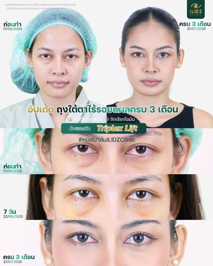 ผ่าตัดถุงใต้ตา