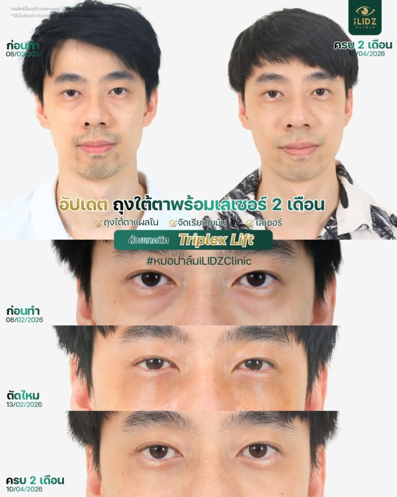 ผ่าตัดถุงใต้ตา