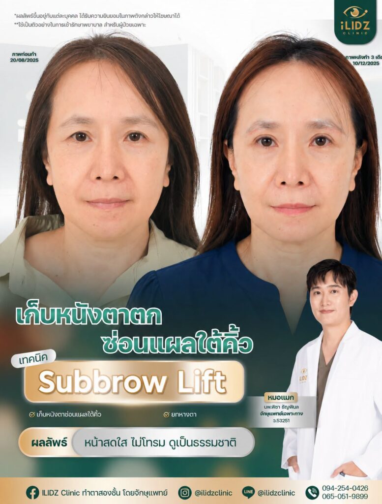 subbrow lift