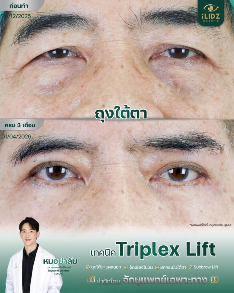 ตาสองชั้น พร้อมถุงใต้ตา