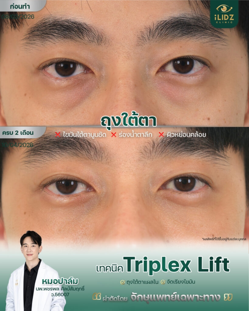 ผลผ่าตัดถุงใต้ตา Lower Blepharoplasty หลังทำ iLIDZ Clinic