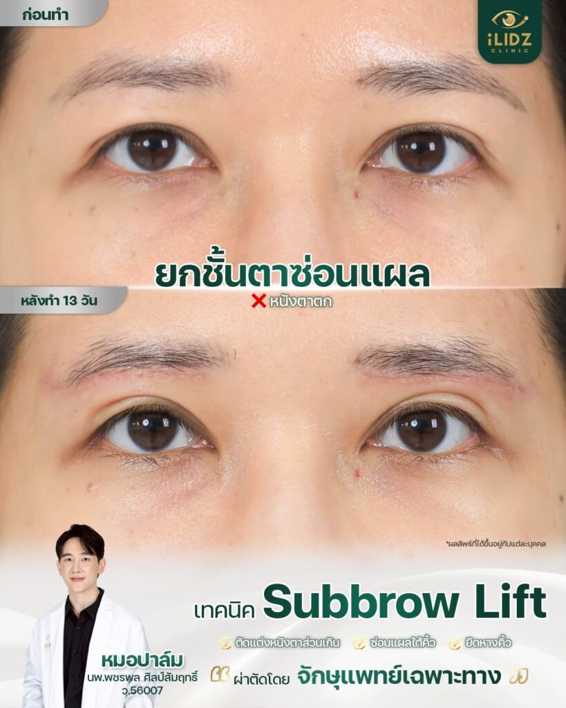 Subbrow Lift เก็บหนังตาตก