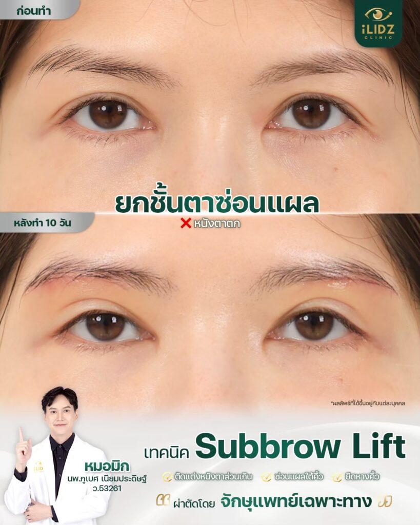 Subbrow Lift เก็บหนังตาตก