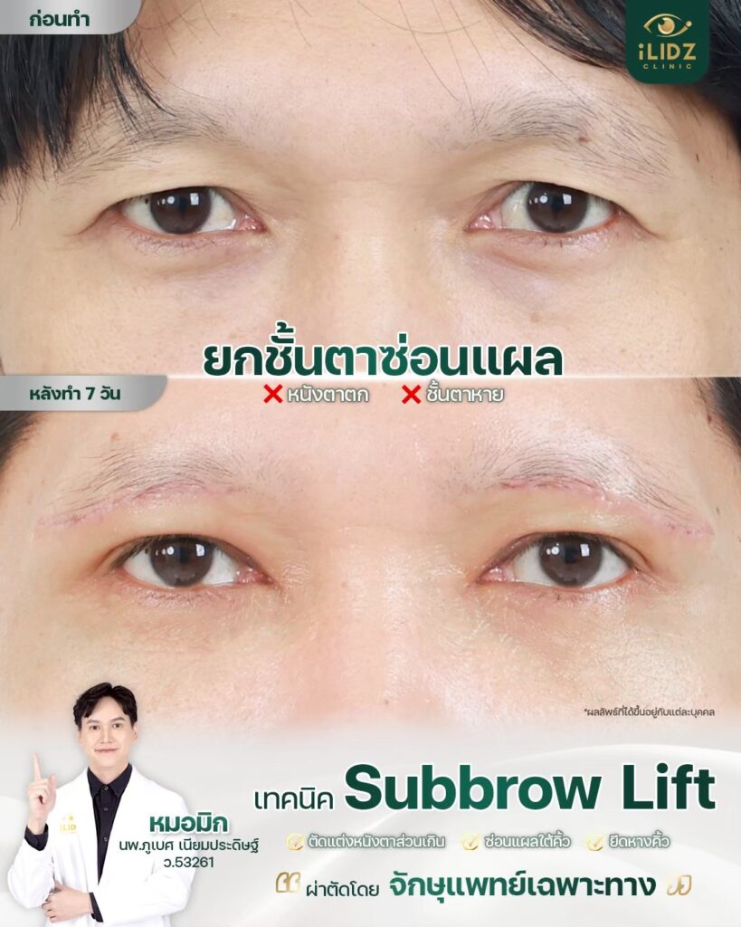 Subbrow Lift เก็บหนังตาตก