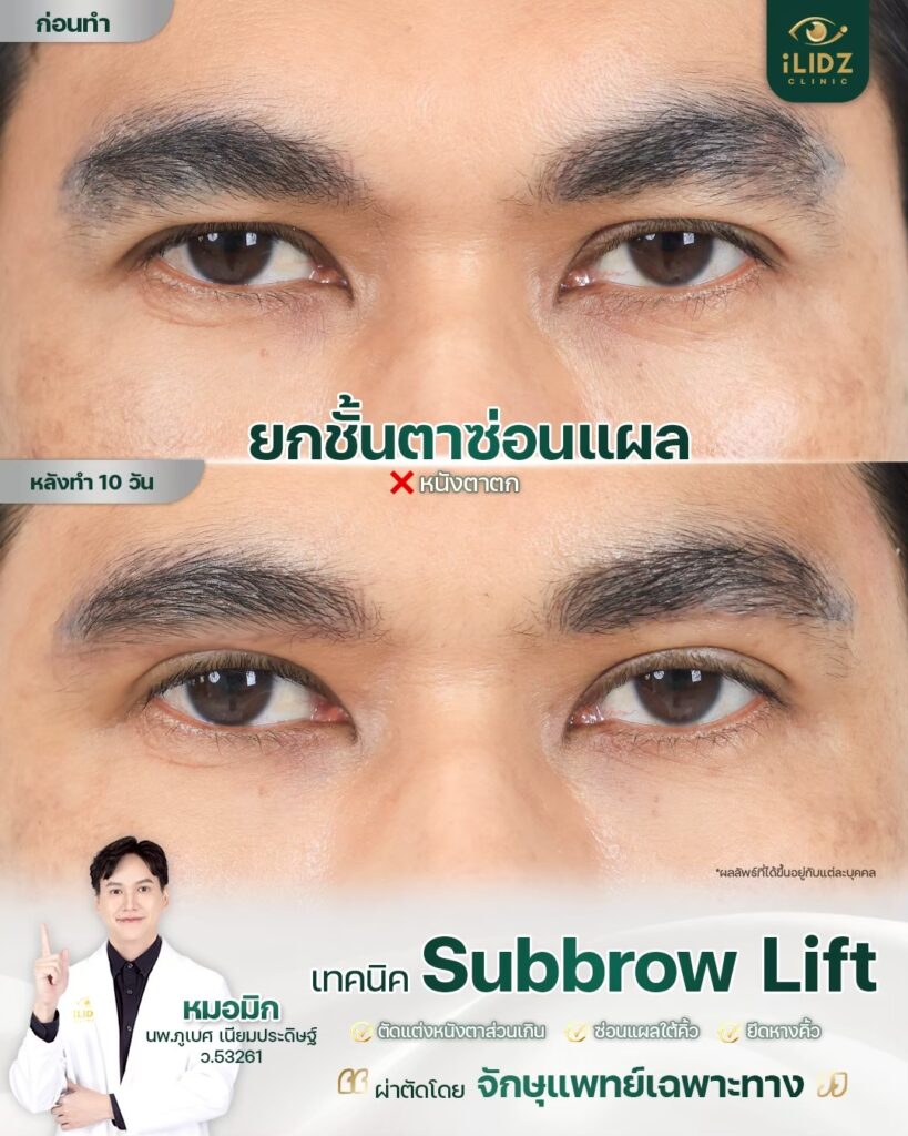 Subbrow Lift เก็บหนังตาตก