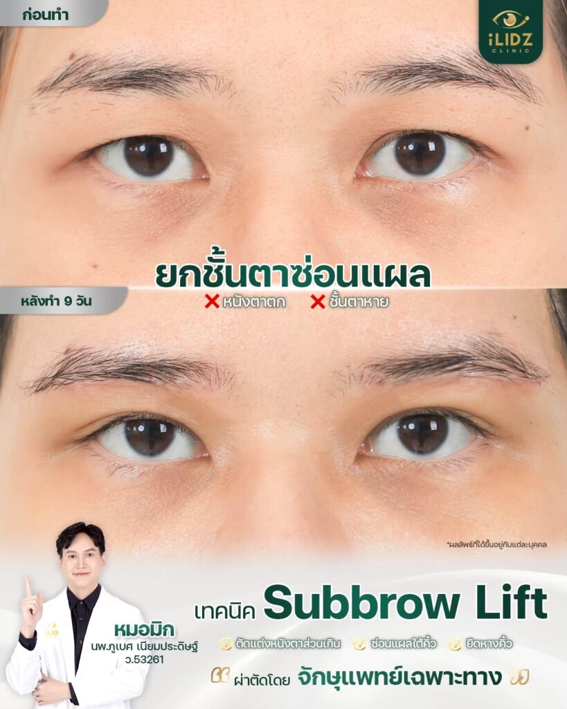 Subbrow Lift เก็บหนังตาตก