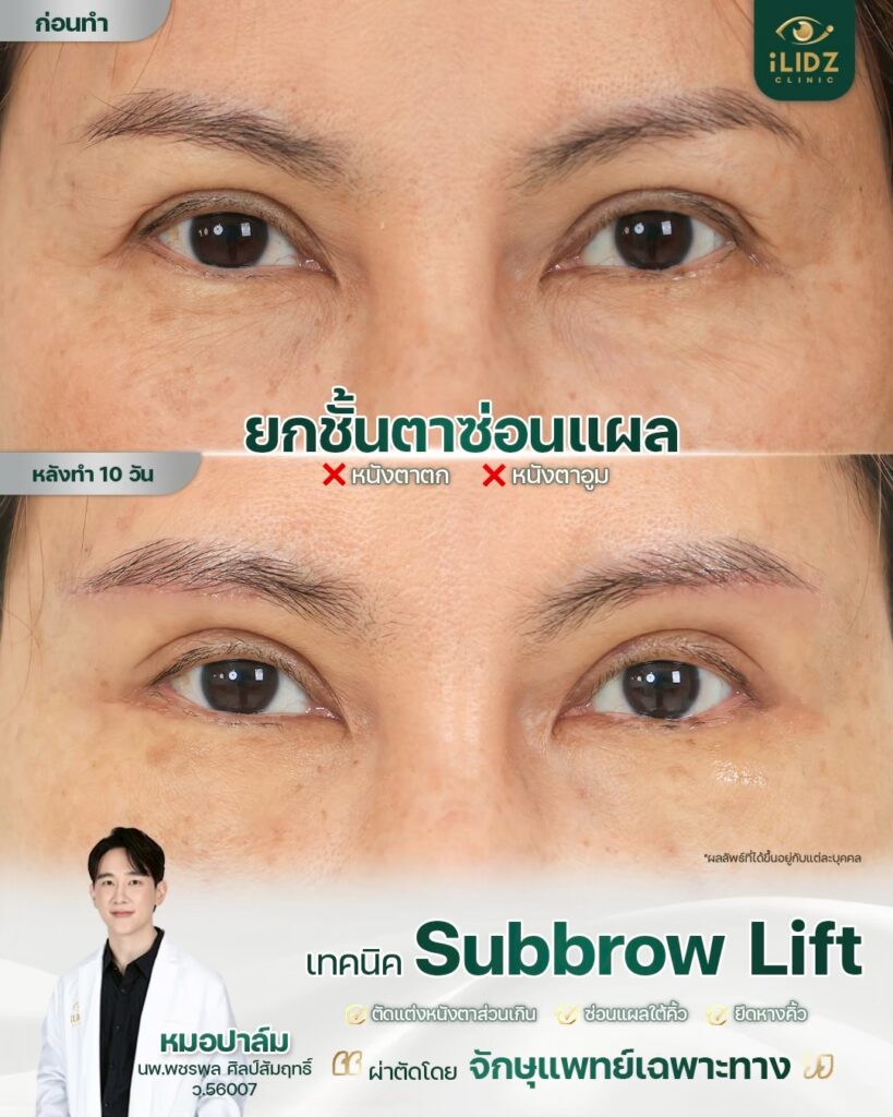 Subbrow Lift เก็บหนังตาตก