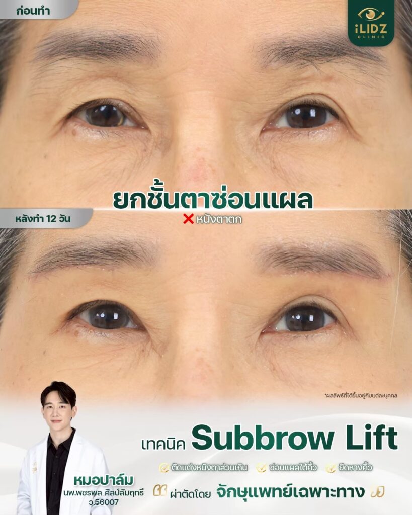 Subbrow Lift เก็บหนังตาตก