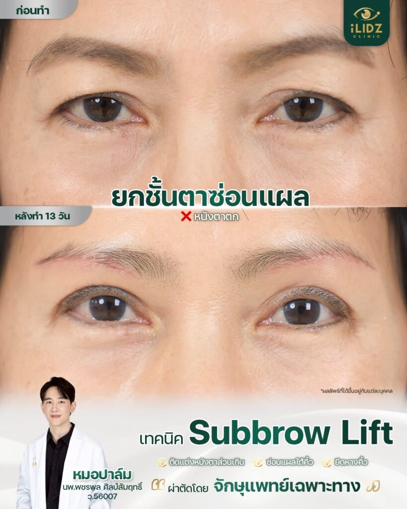 Subbrow Lift เก็บหนังตาตก