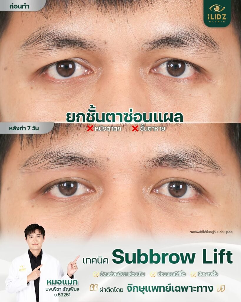 Subbrow Lift เก็บหนังตาตก
