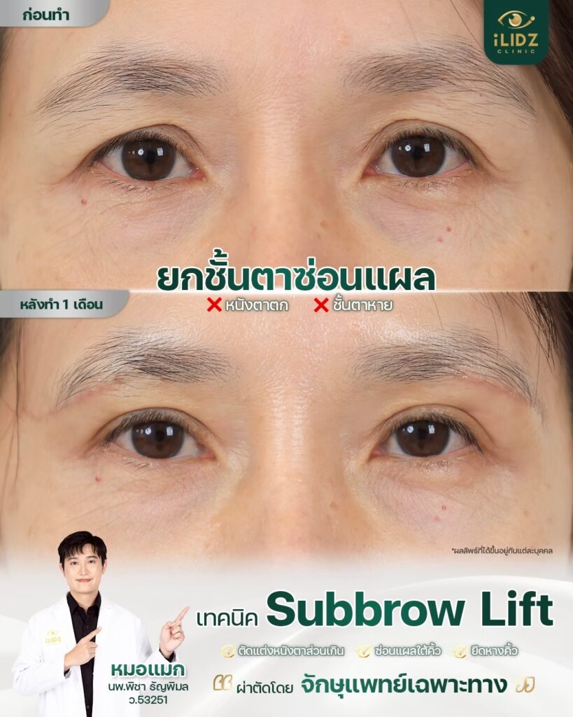 Subbrow Lift เก็บหนังตาตก