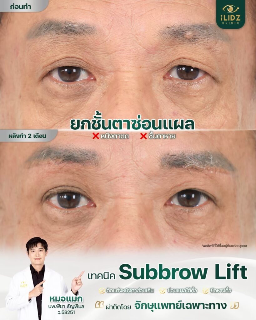 Subbrow Lift เก็บหนังตาตก
