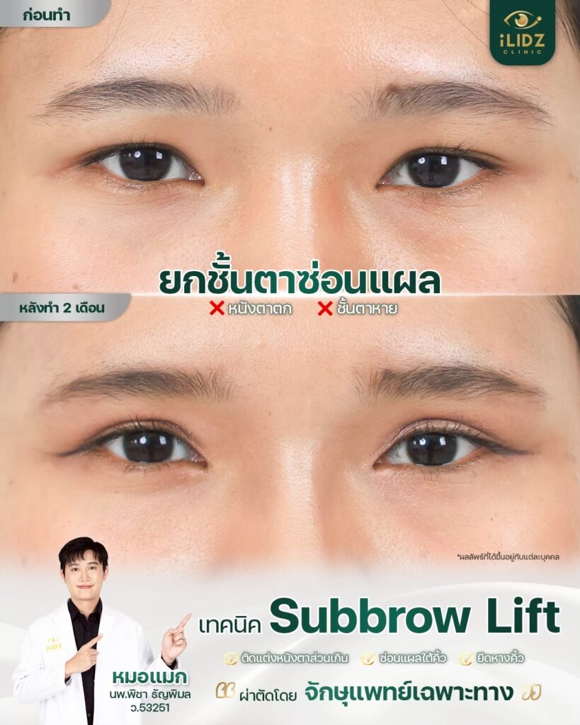 Subbrow Lift เก็บหนังตาตก
