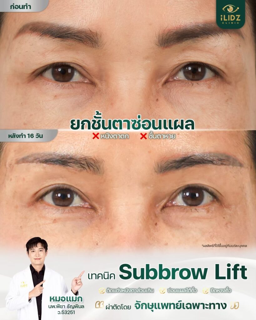 Subbrow Lift เก็บหนังตาตก
