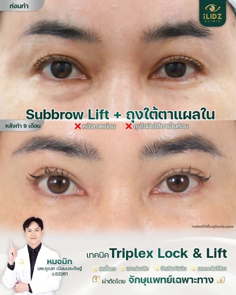 ตาสองชั้น พร้อมถุงใต้ตา
