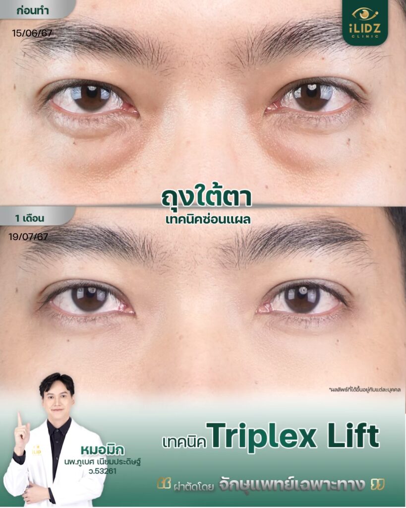 ถุงใต้ตา ก่อนผ่าตัด Lower Blepharoplasty หมอมิก iLIDZ Clinic