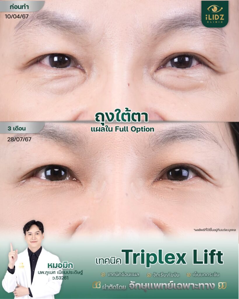 ผลผ่าตัดถุงใต้ตา Lower Blepharoplasty หลังทำ โดยหมอมิก iLIDZ Clinic