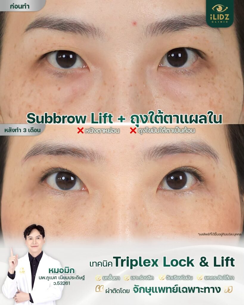 ตาสองชั้น พร้อมถุงใต้ตา