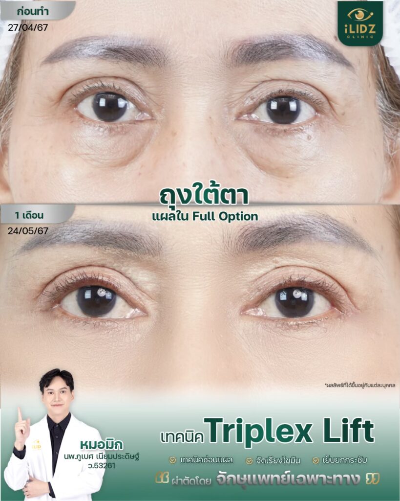 ถุงใต้ตา ก่อนผ่าตัด Lower Blepharoplasty หมอมิก iLIDZ Clinic