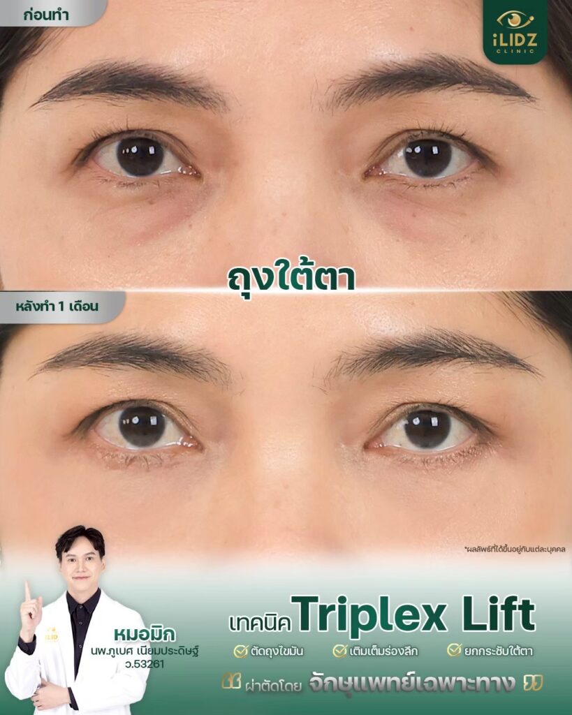 ถุงใต้ตา ก่อนผ่าตัด Lower Blepharoplasty หมอมิก iLIDZ Clinic
