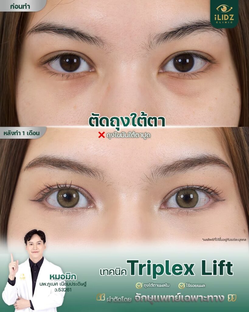 ถุงใต้ตา ก่อนผ่าตัด Lower Blepharoplasty หมอมิก iLIDZ Clinic
