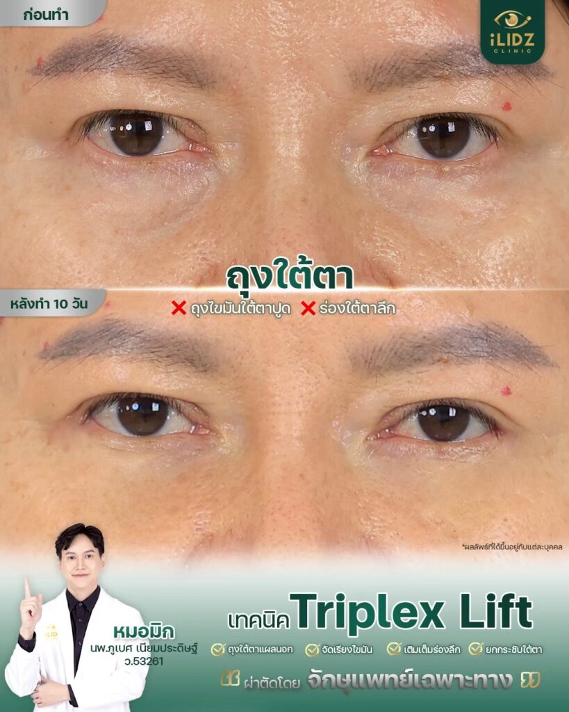 ผลผ่าตัดถุงใต้ตา Lower Blepharoplasty หลังทำ โดยหมอมิก iLIDZ Clinic