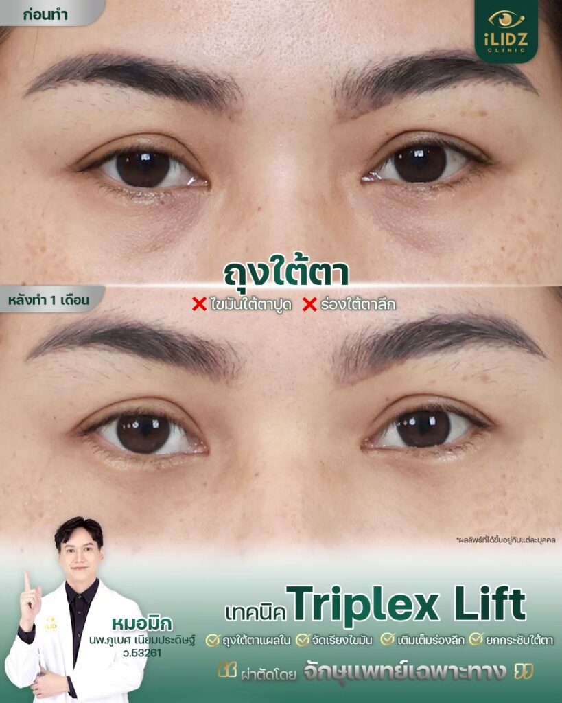 ถุงใต้ตา ก่อนผ่าตัด Lower Blepharoplasty หมอมิก iLIDZ Clinic